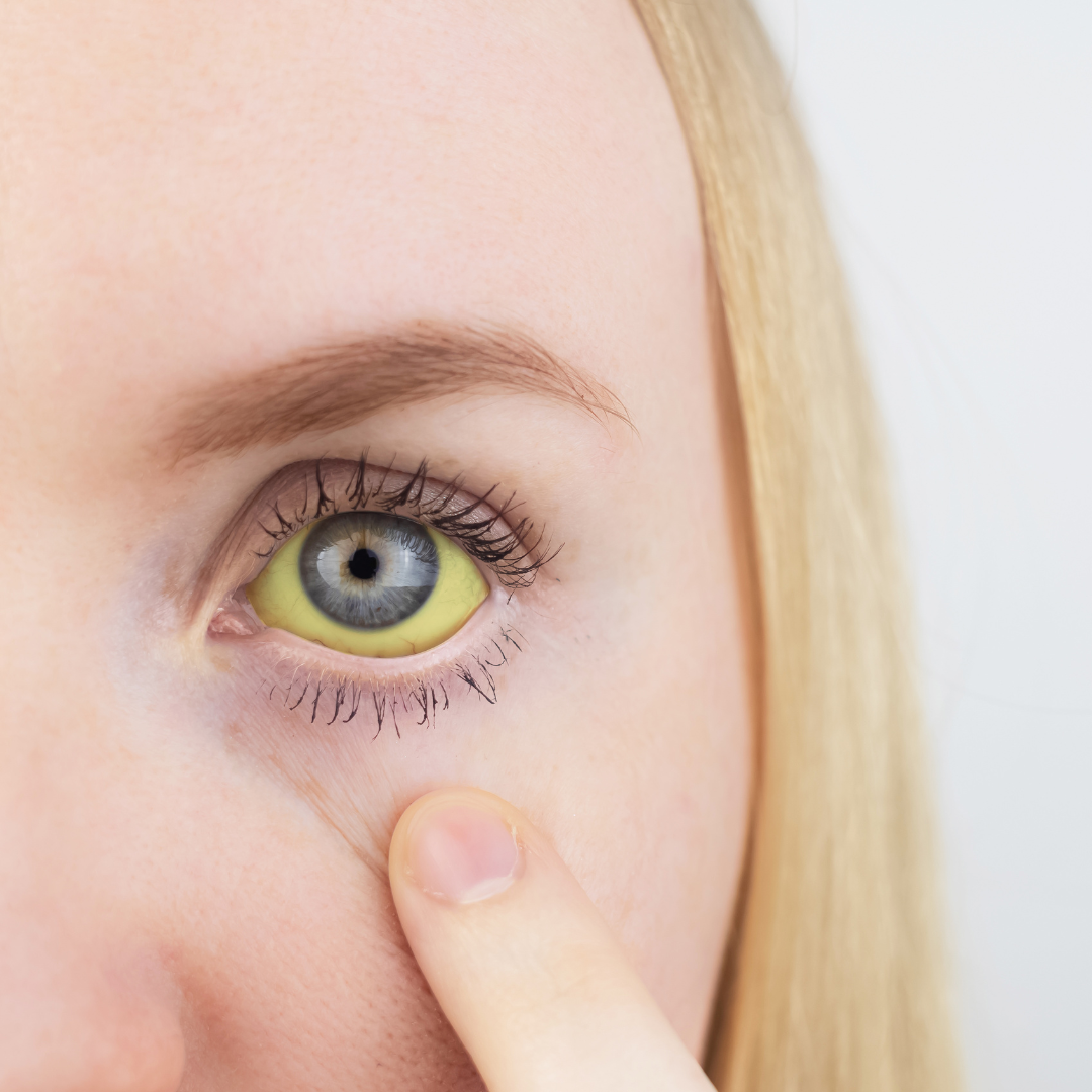 Esteatose Hepática e Inflamação